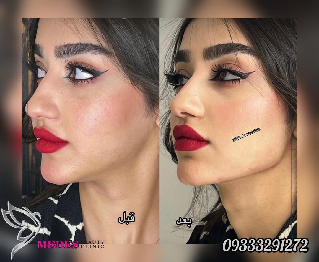 گالری زاویه سازی صورت